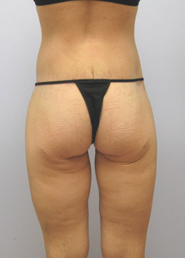 Inner Thigh Lift Before & After Image