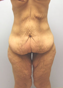 Inner Thigh Lift Before & After Image