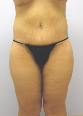 Inner Thigh Lift Before & After Image