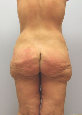 Inner Thigh Lift Before & After Image