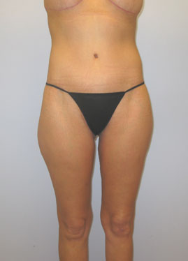 Inner Thigh Lift Before & After Image