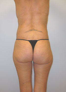 Inner Thigh Lift Before & After Image