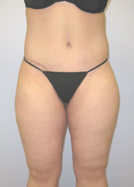 Inner Thigh Lift Before & After Image