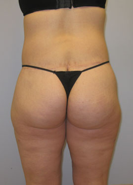 Inner Thigh Lift Before & After Image