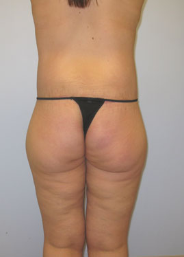 Inner Thigh Lift Before & After Image