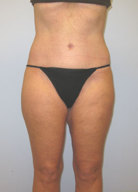 Inner Thigh Lift Before & After Image