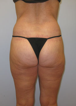 Inner Thigh Lift Before & After Image