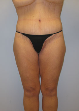 Inner Thigh Lift Before & After Image