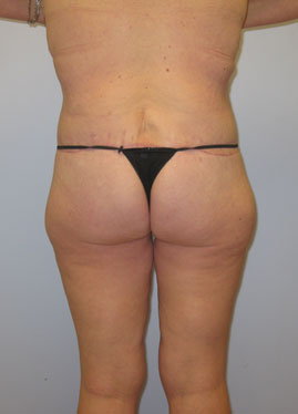 Inner Thigh Lift Before & After Image