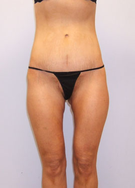 Inner Thigh Lift Before & After Image