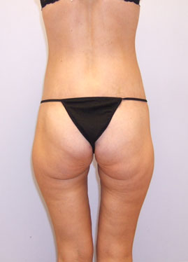 Inner Thigh Lift Before & After Image