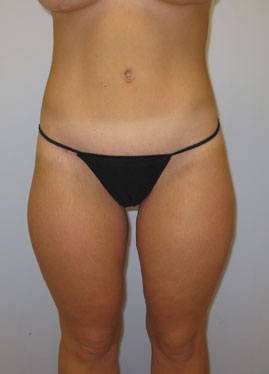 Inner Thigh Lift Before & After Image