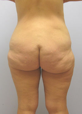 Inner Thigh Lift Before & After Image