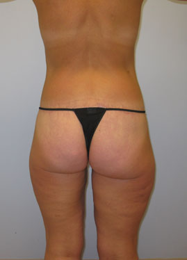 Inner Thigh Lift Before & After Image