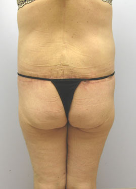 Inner Thigh Lift Before & After Image