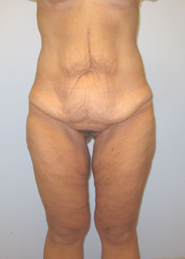 Inner Thigh Lift Before & After Image