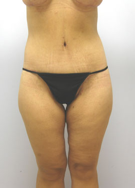 Inner Thigh Lift Before & After Image