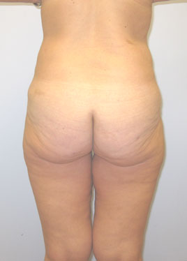 Inner Thigh Lift Before & After Image