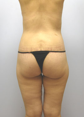 Inner Thigh Lift Before & After Image