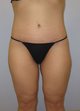 Inner Thigh Lift Before & After Image