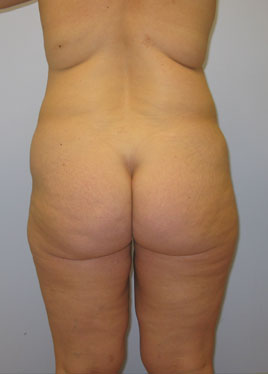 Inner Thigh Lift Before & After Image