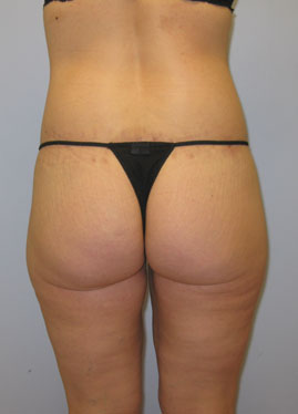 Inner Thigh Lift Before & After Image