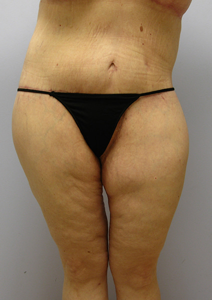 Inner Thigh Lift Before & After Image