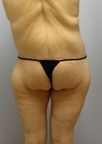 Inner Thigh Lift Before & After Image