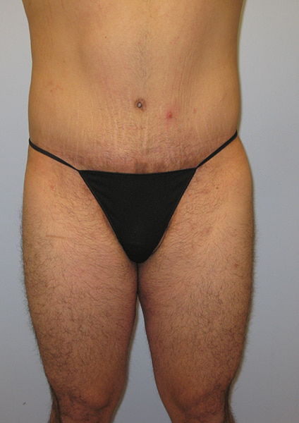 Inner Thigh Lift Before & After Image