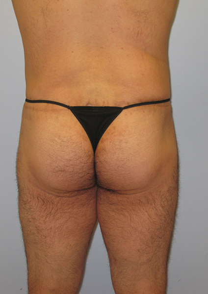 Inner Thigh Lift Before & After Image