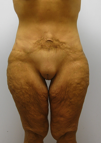 Inner Thigh Lift Before & After Image