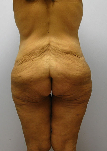 Inner Thigh Lift Before & After Image