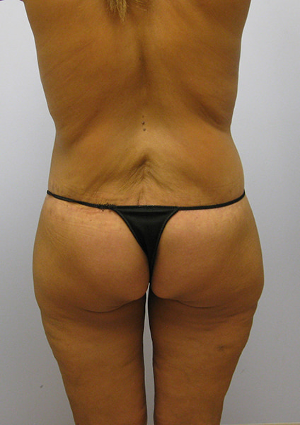 Inner Thigh Lift Before & After Image