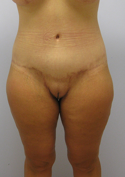 Inner Thigh Lift Before & After Image