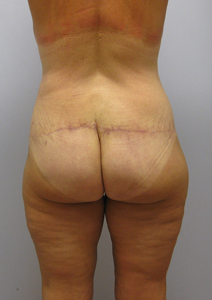 Inner Thigh Lift Before & After Image