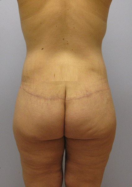 Inner Thigh Lift Before & After Image