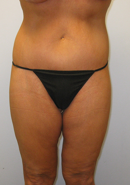 Inner Thigh Lift Before & After Image