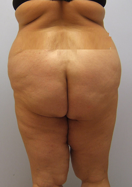 Inner Thigh Lift Before & After Image