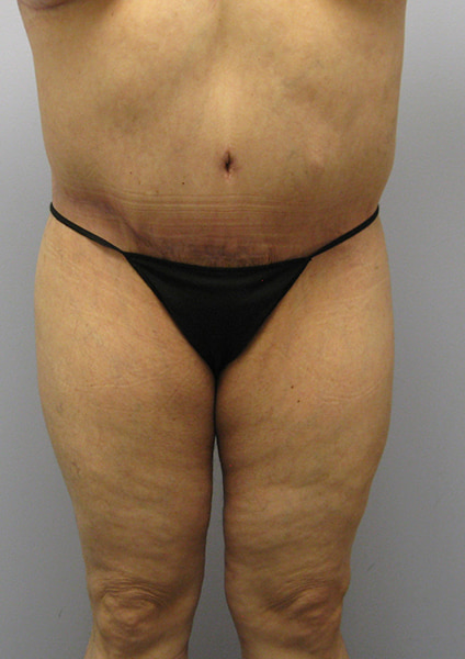 Inner Thigh Lift Before & After Image