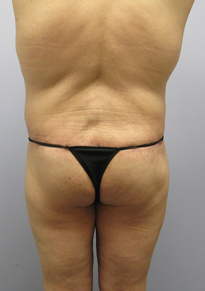 Inner Thigh Lift Before & After Image