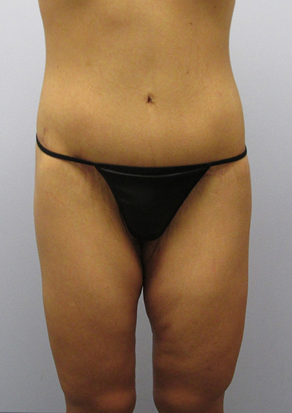 Inner Thigh Lift Before & After Image