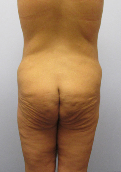 Inner Thigh Lift Before & After Image