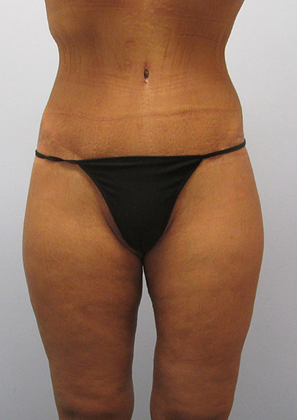 Inner Thigh Lift Before & After Image