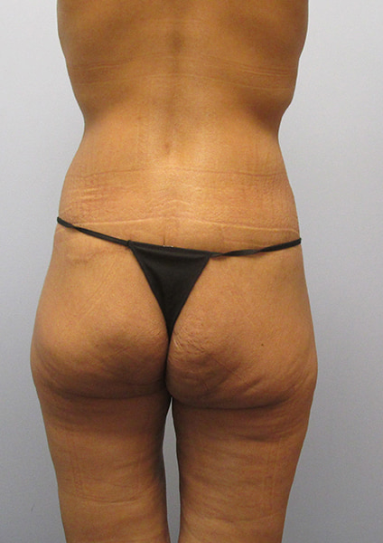 Inner Thigh Lift Before & After Image