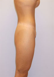 Thigh Lift Before & After Image