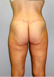 Thigh Lift Before & After Image