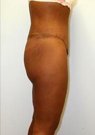 Thigh Lift Before & After Image