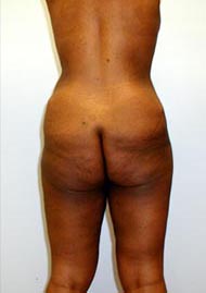 Thigh Lift Before & After Image