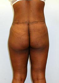 Thigh Lift Before & After Image