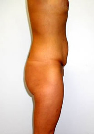 Thigh Lift Before & After Image